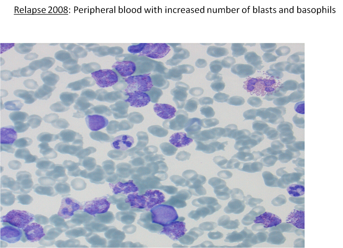 Fig 8. Blood smear at relapse